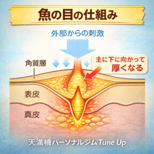 外部からの刺激で角質が下方向に厚くなり、芯が内側に押し込まれる魚の目の構造図｜足裏・皮膚断面イラスト